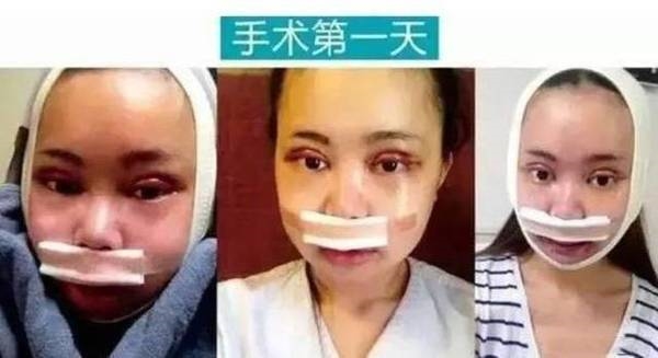 Bản sao hoàn mỹ nhất của AngelaBaby chi tiền khủng để sửa mặt