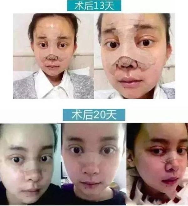 Bản sao hoàn mỹ nhất của AngelaBaby chi tiền khủng để sửa mặt