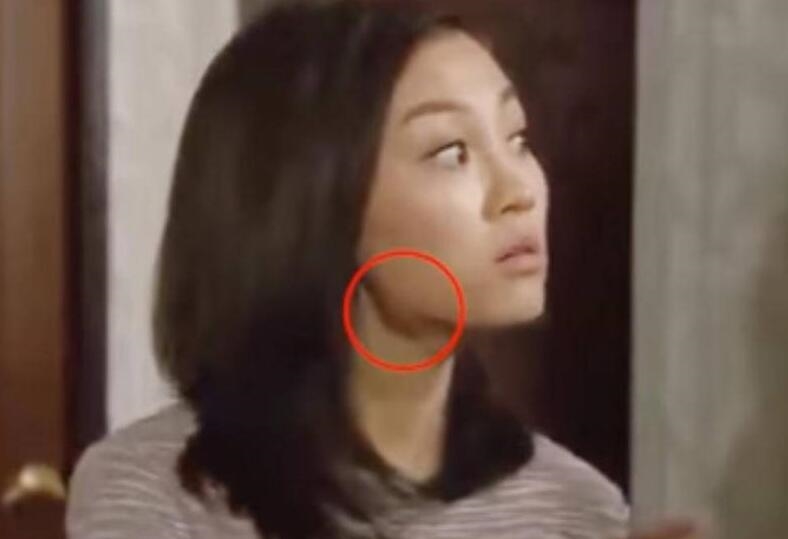 Fan hết hồn vì hoa đán TVB để lộ khối u to như bóng bàn ở cổ