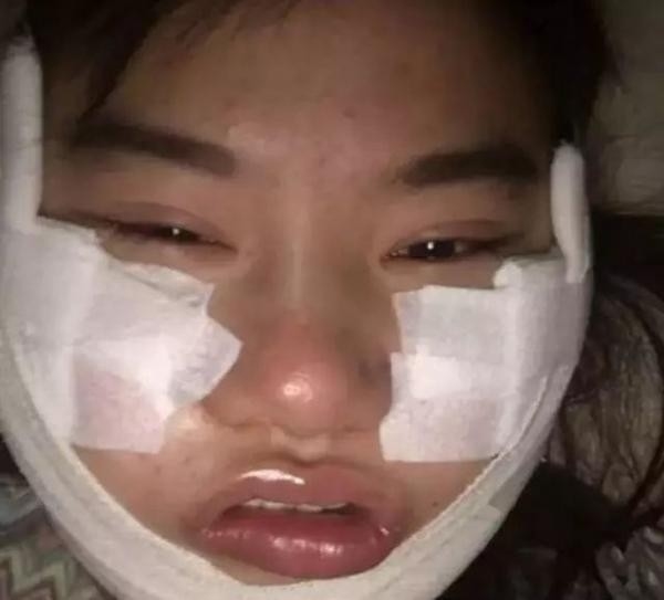 Dương Mịch đau đầu vì fan cuồng lại chi tiền tỷ để dao kéo khuôn mặt