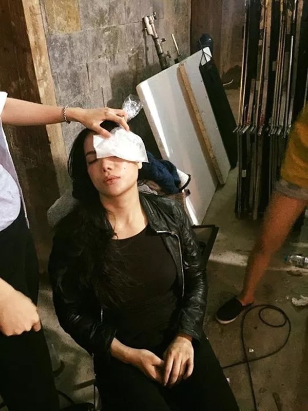 Sao Việt gặp chấn thương nguy hiểm trên phim trường