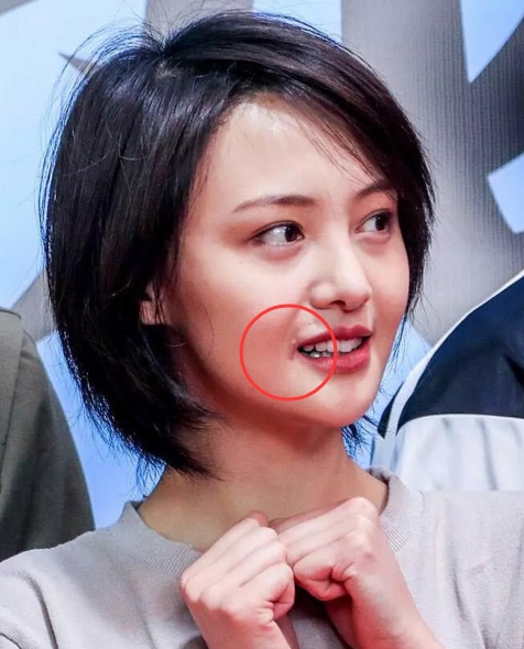 Trịnh Sảng xuất hiện với một bên mắt băng kín mít khiến fan xót xa