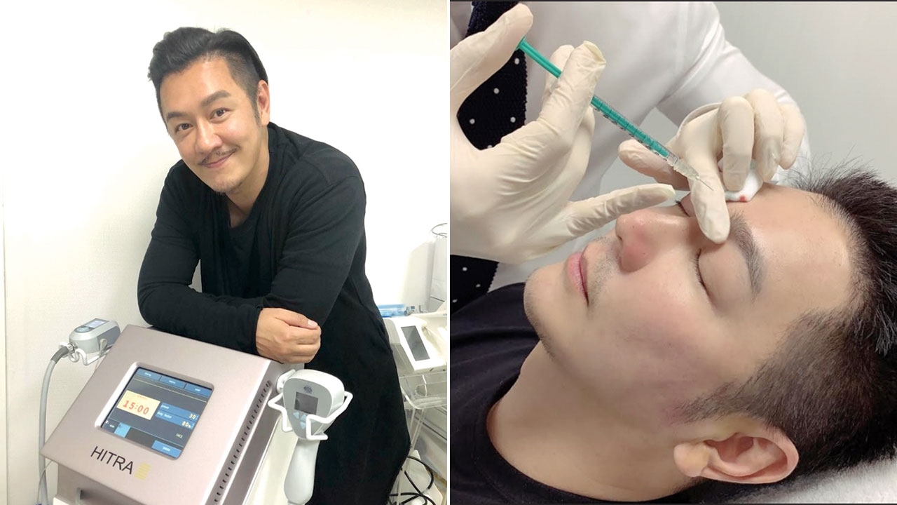 'Đoàn Dự' Trần Hạo Dân khoe ảnh tiêm botox để lưu giữ tuổi xuân