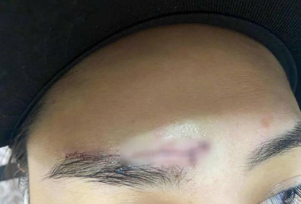 Chung Hân Đồng khiến Cnet xót xa vì vết thương khâu chục mũi trên trán