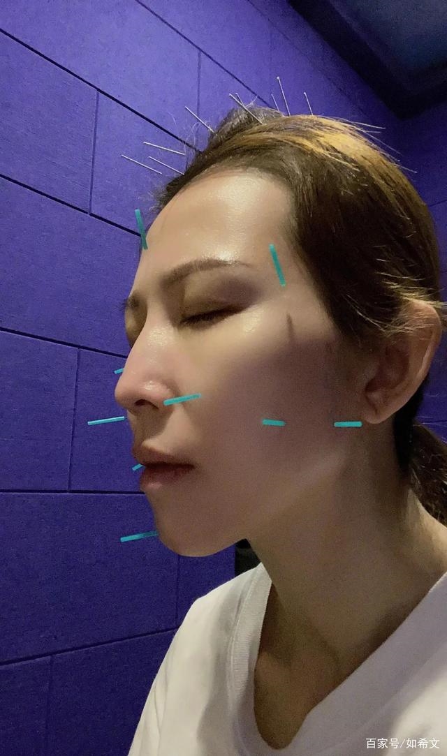 Thái Thiếu Phân và dàn mỹ nhân Cbiz châm cứu mặt để làm đẹp