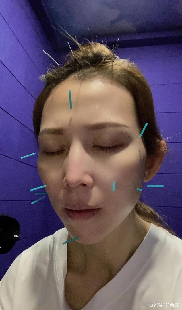 Thái Thiếu Phân và dàn mỹ nhân Cbiz châm cứu mặt để làm đẹp