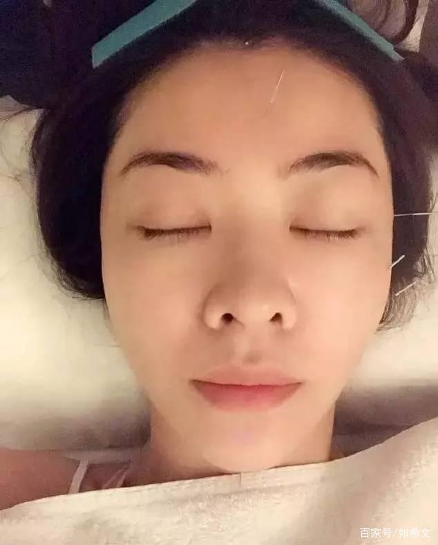 Thái Thiếu Phân và dàn mỹ nhân Cbiz châm cứu mặt để làm đẹp